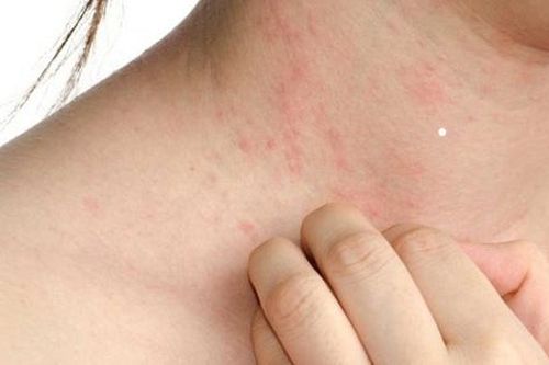 Dị ứng thời tiết cần kiêng gì?