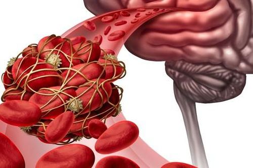 Yếu tố nguy cơ dễ bị đột quỵ mùa lạnh
