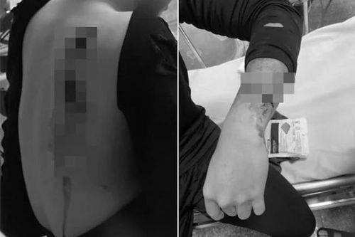 Đang đi trên đường, nam sinh Hà Nội bất ngờ bị chém đứt gân