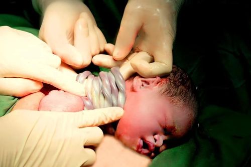 Trẻ chào đời với 9 vòng dây rốn quấn cổ