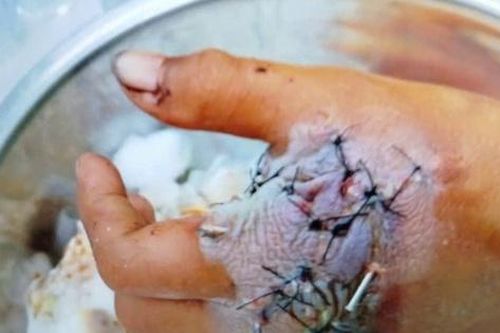 Tự chế pháo nổ do mua trên mạng, 3 bệnh nhi phải cấp cứu tại bệnh viện