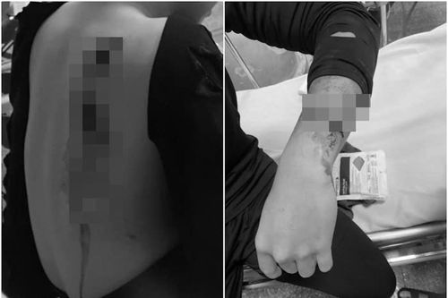 Nam sinh Hà Nội bị nhóm thanh thiếu niên cầm hung khí đuổi chém giữa phố