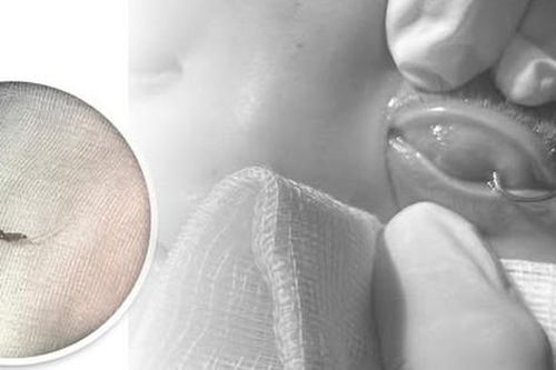 Bé trai bị lưỡi câu móc vào mắt