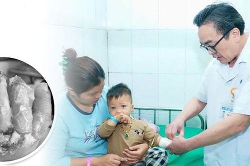 Cảnh báo chữa bỏng bằng mẹo dân gian