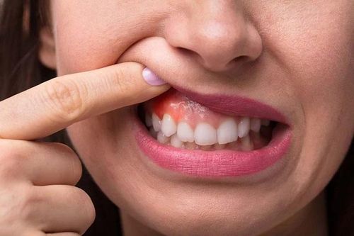 Những bệnh về răng miệng thường gặp cần chú ý