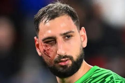 Donnarumma suýt bị mù sau cú đạp kinh hoàng