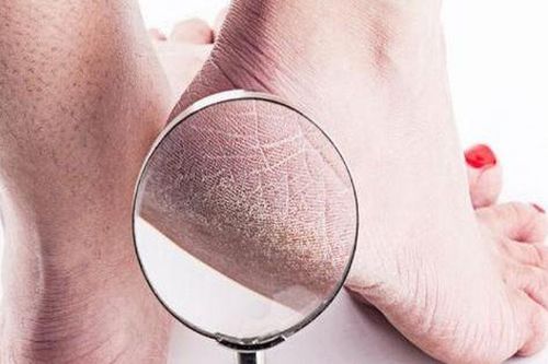 Chăm sóc nẻ gót chân mùa lạnh