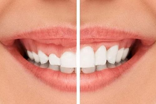 Thực hiện phẫu thuật cắt lợi bao nhiêu tiền