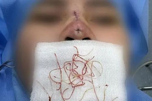 Những biến chứng khó lường khi căng chỉ nâng mũi