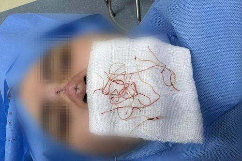 Bác sĩ gắp từng sợi chỉ để giải cứu chiếc mũi cho cô gái trẻ