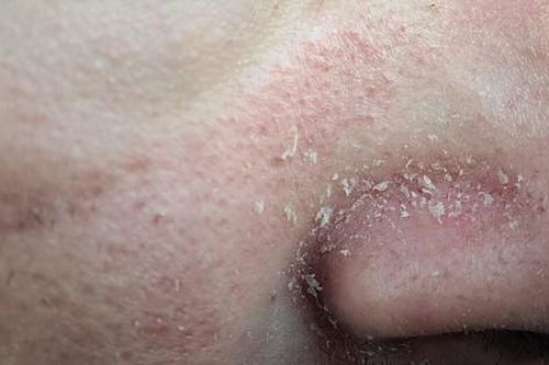 14 lý do khiến da mặt bị bong tróc vảy thường xuyên