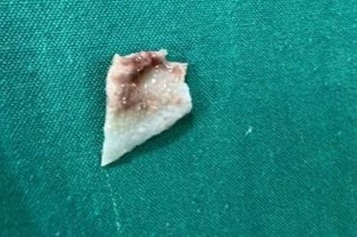 Bé gái phải cấp cứu nội soi vì sự cố khi ăn cháo