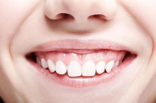 Điều trị cười hở lợi bằng niềng răng