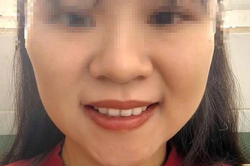 Khuôn mặt méo mó sau khi tiêm botox