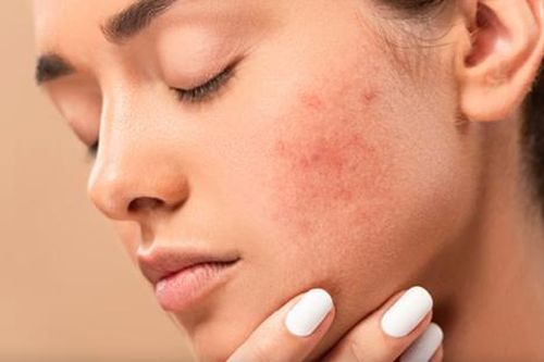 Nên làm gì để giảm thiểu tình trạng kích ứng da do mỹ phẩm?