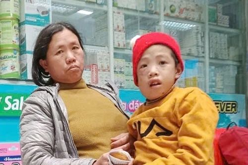 Khuôn mặt biến dạng vì bệnh hiếm, bé trai cần 2 tỷ đồng để ghép tủy