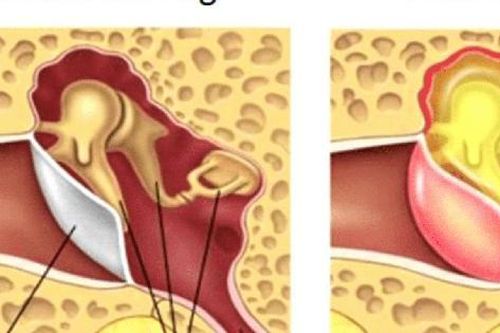 Người bệnh viêm tai giữa tập luyện như thế nào?