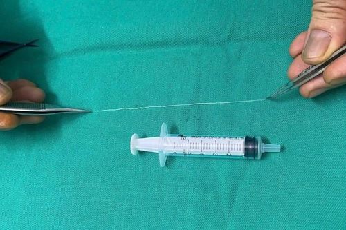 Bác sĩ bất ngờ khi gắp giun dài 14 cm từ mắt người phụ nữ