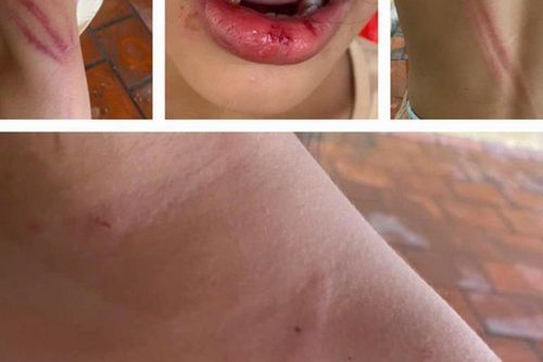 Vụ bé gái 10 tuổi bị cha dượng đánh đập ở Bình Dương: Có thể khởi tố vụ án trong trường hợp nào?