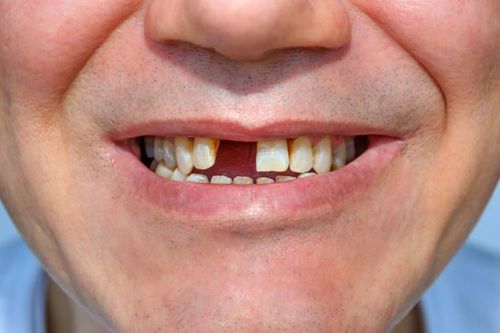 Nhật Bản chế thuốc giúp răng rụng mọc lại
