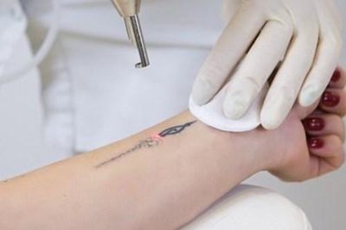 Bị tai biến thẩm mỹ do xóa vết xăm ở cơ sở không phép