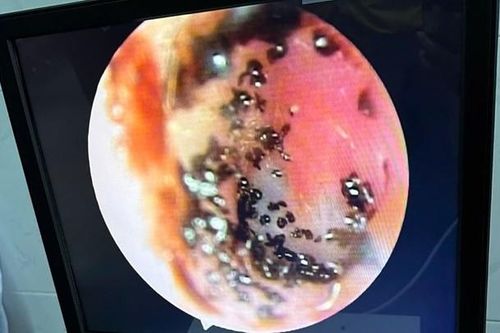 Bầy ve rận ký sinh trong ống tai bệnh nhi 6 tuổi