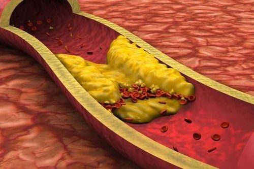 7 loại vitamin giúp ngăn ngừa xơ vữa động mạch