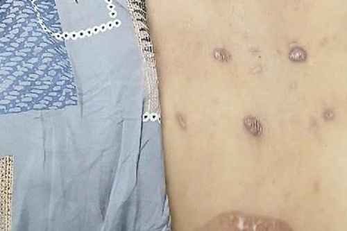 Người loang lổ sẹo do đốt thuốc của 'lang vườn' trị đau lưng