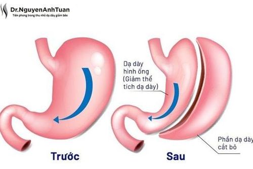 Hành trình cải thiện cân nặng và sức khỏe sau 8 tháng phẫu thuật thu nhỏ dạ dày