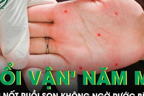 Xăm nốt ruồi son 'đổi vận': Vận chưa đổi đã rước thêm bệnh