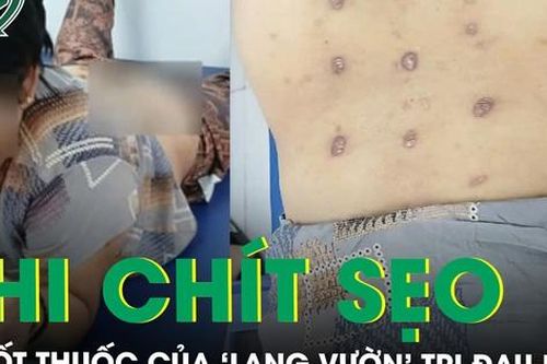 Đốt thuốc của 'lang vườn' trị đau lưng, bệnh không khỏi mà lưng chi chít sẹo