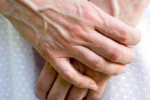 Tay nổi gân xanh là dấu hiệu của bệnh gì?