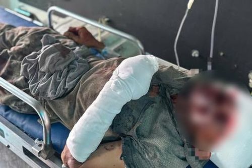 Một người bị thương nặng sau tiếng nổ lớn tại hầm đá