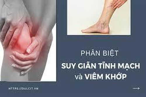 Mỏi chân, nhức gối có phải bệnh suy giãn tĩnh mạch?