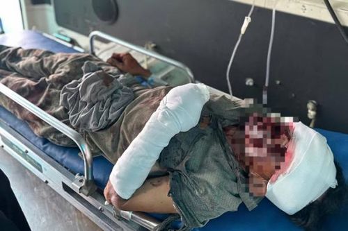 Nổ lớn tại điểm khai thác đá lậu, người đàn ông nguy kịch
