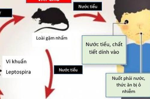 Sốt cao liên tục, 2 trẻ nhập viện trong tình trạng nặng vì nhiễm loại xoắn khuẩn nguy hiểm