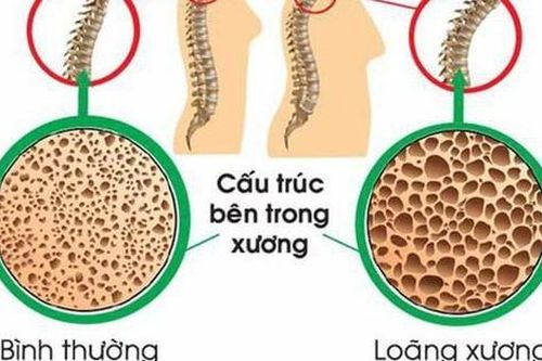 Mối nguy hiểm tiềm ẩn khi phụ nữ thiếu canxi