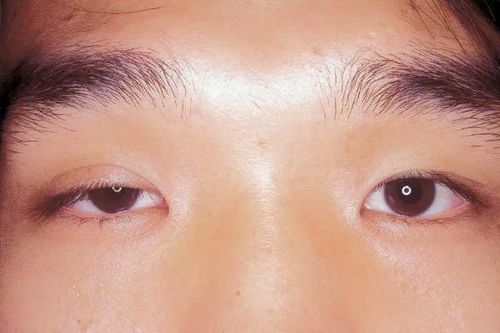 Vật lý trị liệu cho người mắc hội chứng Horner
