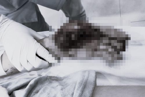 Nam sinh ở Bình Dương bị dập nát 2 bàn tay vì chơi pháo