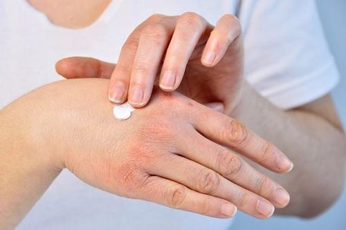 Ngứa da khi trời lạnh, cần làm gì để nhanh khỏi?