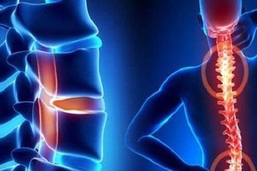 5 câu hỏi thường gặp với người bệnh hẹp ống sống