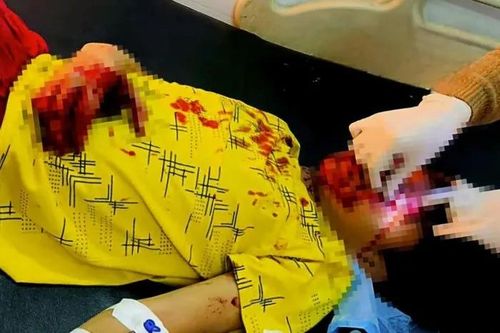 Nam sinh bị dập nát bàn tay do điện thoại phát nổ