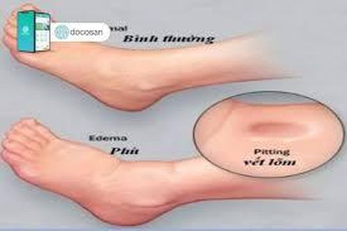 Tình trạng nặng chân, phù nhẹ và nổi nhiều mạch nông là bệnh gì?