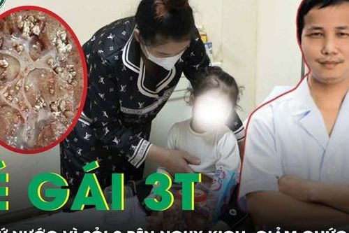 Tán sỏi qua da cứu bé gái 33 tháng tuổi bị sỏi thận hai bên nguy kịch