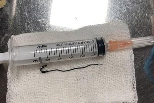 Cứu bé trai 2 tuổi nuốt phải chiếc kim băng sắc nhọn