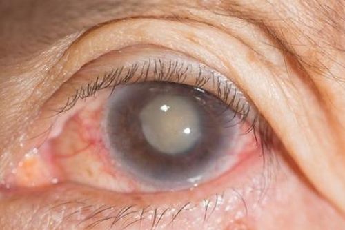 Những nguyên nhân không ngờ khiến người trẻ tuổi bị đục thủy tinh thể