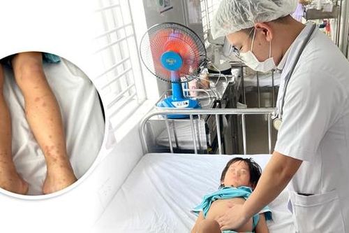Cảnh giác với viêm mao mạch dị ứng ở trẻ từ những biểu hiện dễ bỏ qua dưới đây