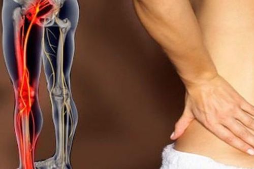 4 lưu ý giúp giảm đau thần kinh tọa