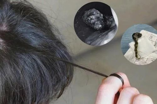 Nguy cơ tắc đường tiêu hóa ở trẻ có sở thích ăn tóc