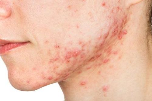 Các thuốc điều trị mụn trứng cá